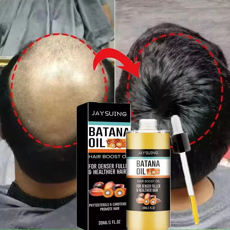 Fast Hair Growth Set Batana Oil Traction Alopecia Hair Mask Anti Break Loss Hair Growth Oil Baldness Treatment Hair Health Care